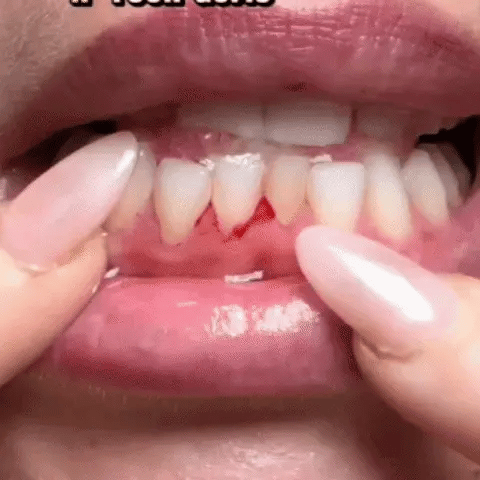 Lovqo Periodontal Care Before and After Case 3