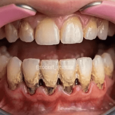 Lovqo Periodontal Care Before and After Case 1
